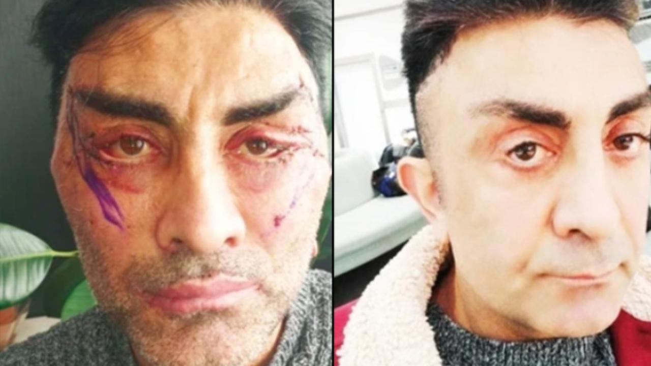 Gençleşmek istedi, hayatı kabusa döndü! 4 ameliyat oldu, gözlerini kapatamıyor